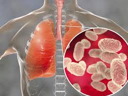 Tlaxcala, sin casos de tos Ferina