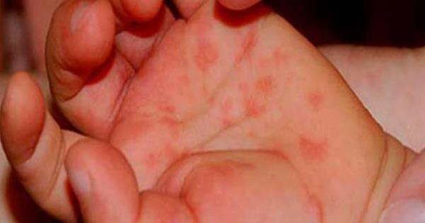 Confirman brote de virus Coxsackie en escuelas de Izúcar de Matamoros y Amalucan.