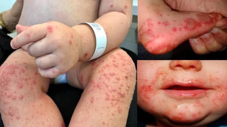 Confirman siete casos de virus Coxsackie en menores