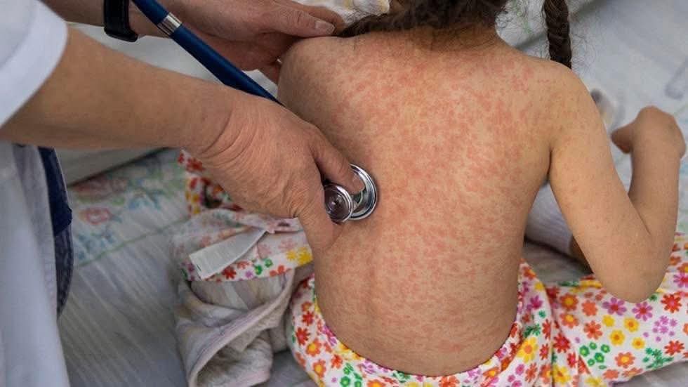 Reportan 141 casos de sarampión en 11 municipios